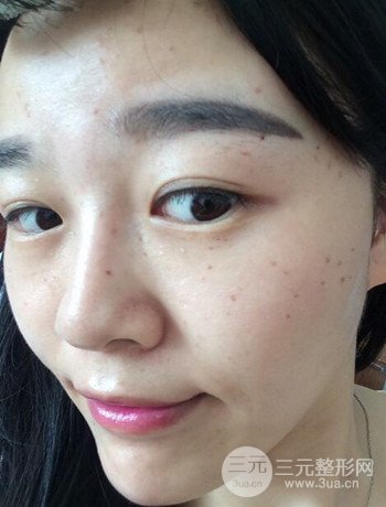 北京激光去雀斑真實(shí)案例分享，純素顏無濾鏡果圖