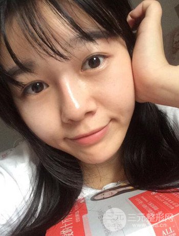 北京激光去雀斑真實(shí)案例分享，純素顏無濾鏡果圖