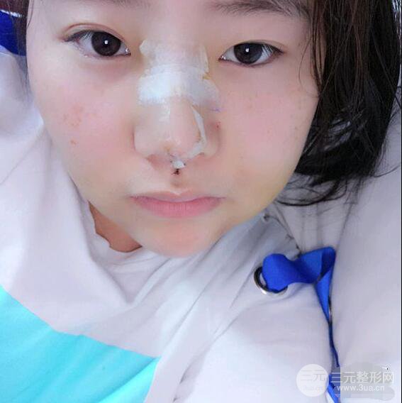 合肥壹加壹甘泉涌軟骨隆鼻前后對(duì)比圖|內(nèi)附真人案例恢復(fù)前過程