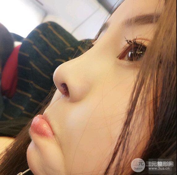 合肥壹加壹甘泉涌軟骨隆鼻前后對(duì)比圖|內(nèi)附真人案例恢復(fù)前過程