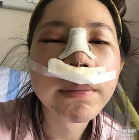 北京聯(lián)合麗格吳焱秋耳軟骨隆鼻前后對比圖|塌鼻子的救星
