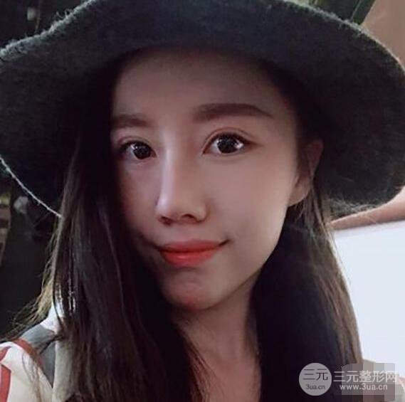 北京聯(lián)合麗格吳焱秋耳軟骨隆鼻前后對比圖|塌鼻子的救星