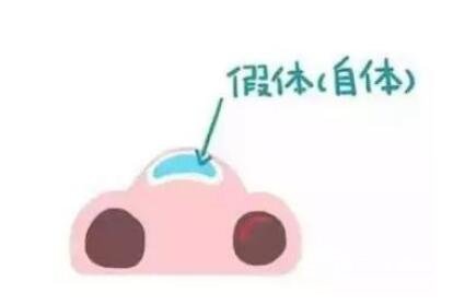 骨膜下隆鼻整形手術(shù)怎么做的？哪種情況適合做？
