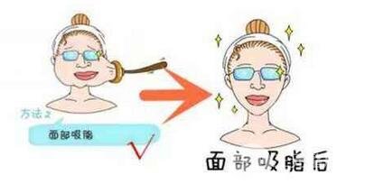 面部吸脂手術