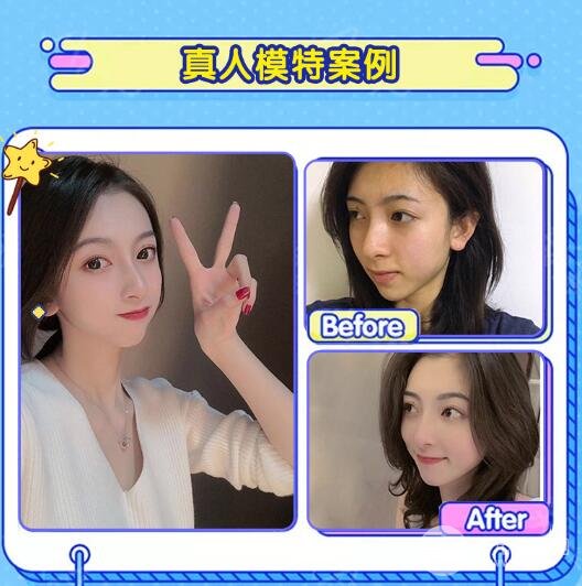 2020年面部吸脂手術(shù)的費用是多少呢?