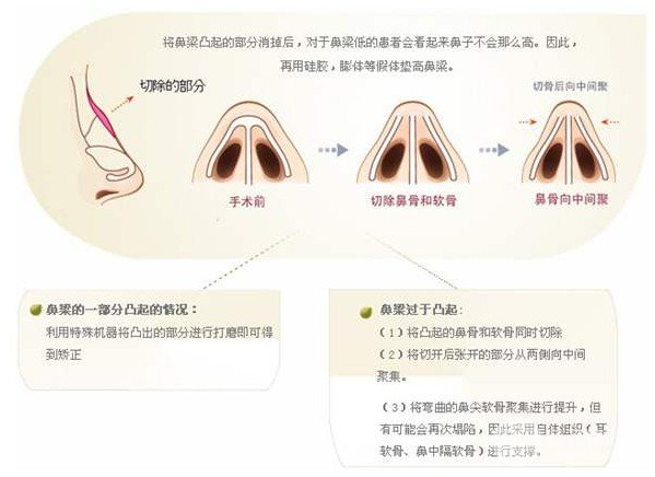 駝峰鼻修復精油