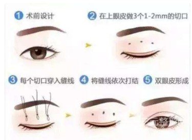 微創(chuàng)定點(diǎn)式好嗎