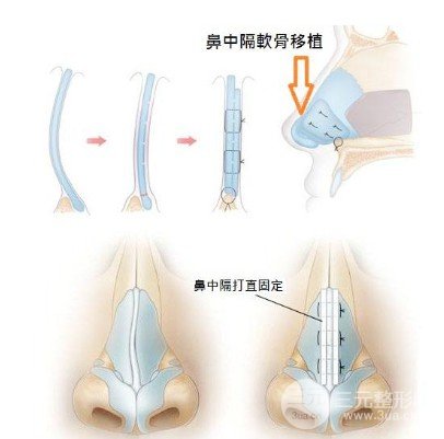 矯正歪鼻的方法