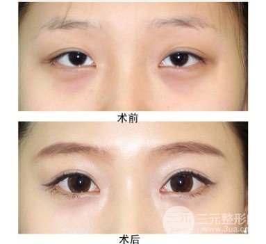開大眼角手術果對比圖