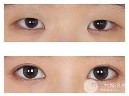 開大眼角手術果對比圖
