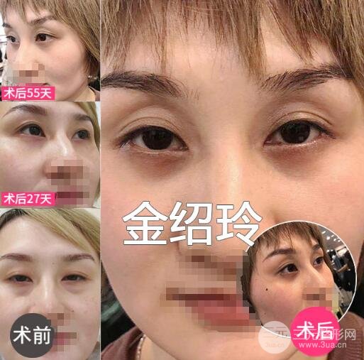 去眼袋果圖