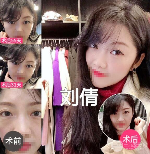 去眼袋果圖