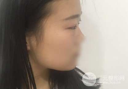 微創(chuàng)去眼袋**嗎