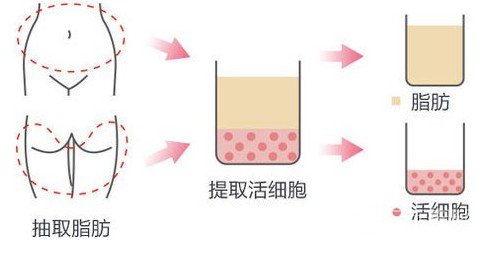 脂肪填充法令紋好嗎
