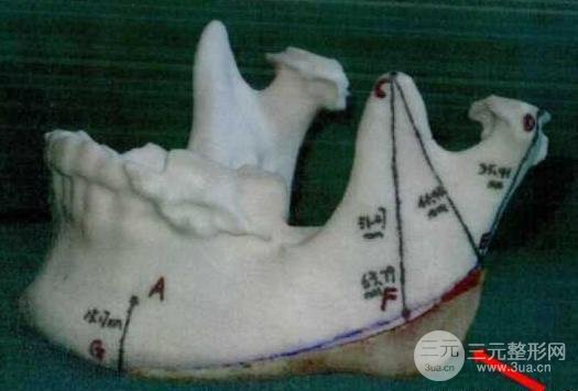 國字臉削骨價(jià)格一般多少錢？手術(shù)注意事項(xiàng)以及案例圖分享~
