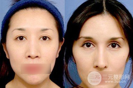 做雙眼皮開眼角注意事項(xiàng)