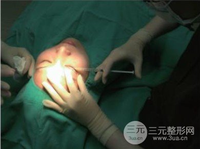 做雙眼皮開眼角注意事項(xiàng)