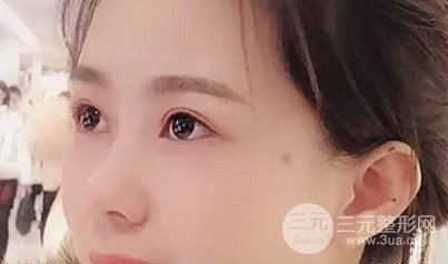 做雙眼皮開眼角注意事項(xiàng)