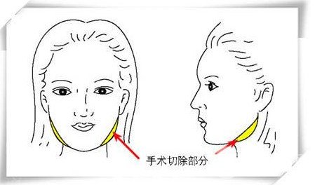 下頜角截骨術(shù)果對比圖