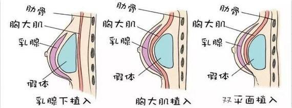 做完隆胸手術后多久可以側(cè)著睡?