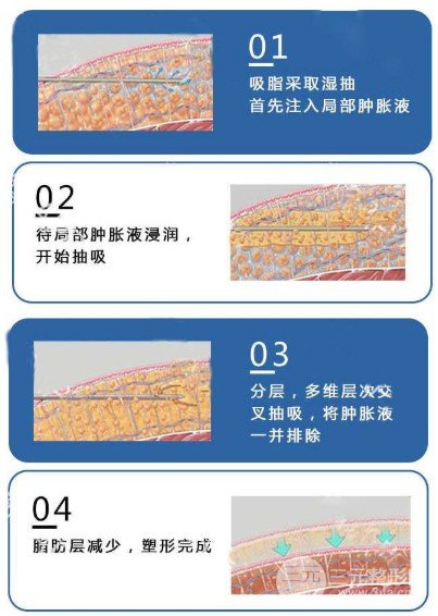 面部吸脂會反彈嗎