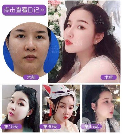 面部吸脂會反彈嗎