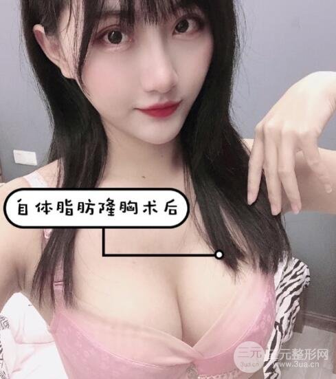 脂肪填充后一個月