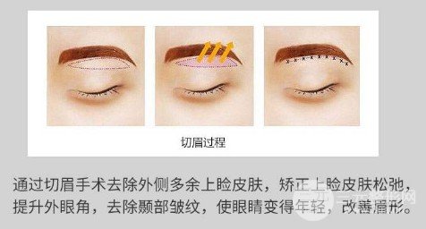 切眉除皺多少錢
