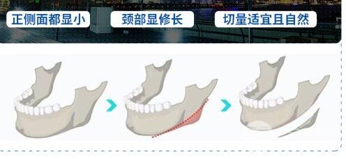 磨下頜角手術(shù)案例合集，磨骨手術(shù)科普~
