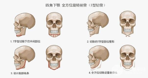 想做下頜角手術(shù)，磨頭還是削骨更好?