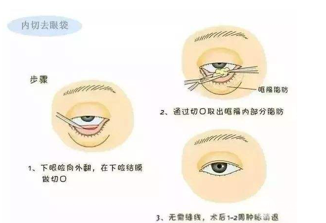 怎樣才能基本去除眼袋