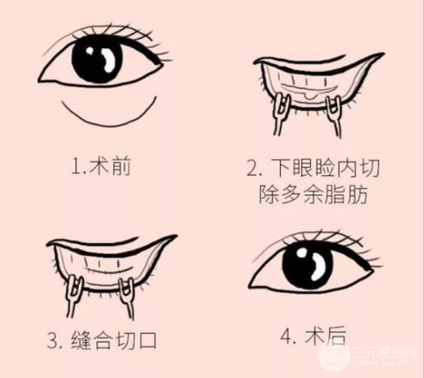 怎樣基本去除眼袋