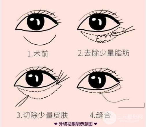 怎樣基本去除眼袋