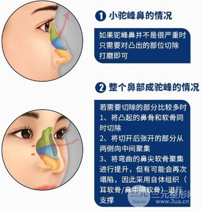 駝峰鼻整形費用貴嗎