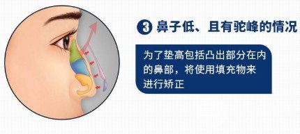駝峰鼻整形費用貴嗎