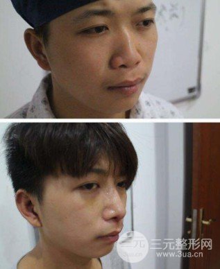 駝峰鼻整形費用貴嗎