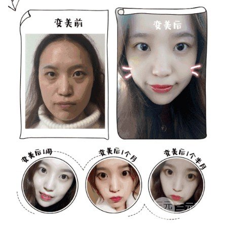 吸脂去眼袋有副作用嗎