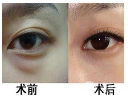 吸脂去眼袋有副作用嗎
