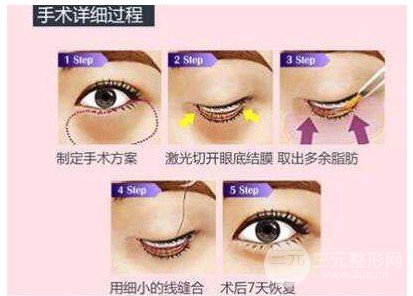 吸脂去眼袋有副作用嗎