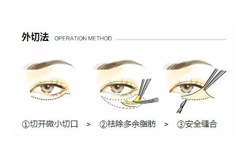 眼袋整形手術(shù)有哪些