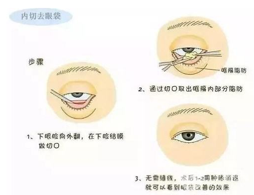 眼袋整形手術(shù)有哪些