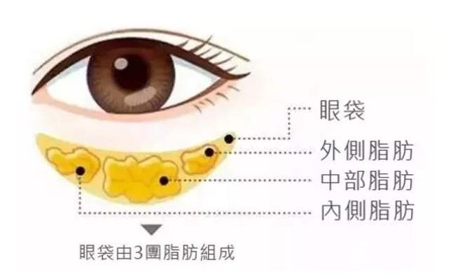 眼袋整形手術(shù)有哪些
