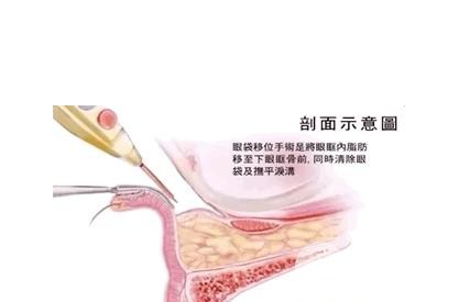 眼袋整形手術(shù)有哪些