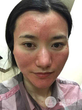 微針毀容圖片|你還敢亂尋醫(yī)嗎