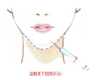 艾莉薇玻尿酸適合打哪里