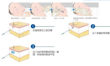 艾莉薇玻尿酸適合打哪里