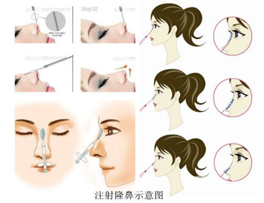 艾莉薇玻尿酸適合打哪里