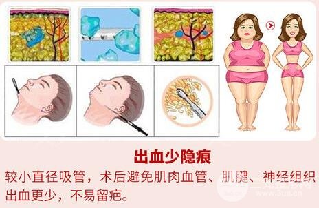 手術(shù)原理