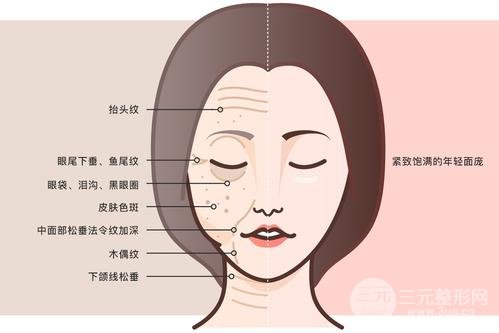中面部除皺術(shù)后恢復(fù)大概要多久?
