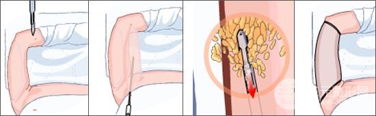 手術(shù)過程